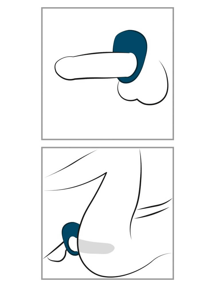 Illustrasjon av hvordan penisring plasseres rundt penis